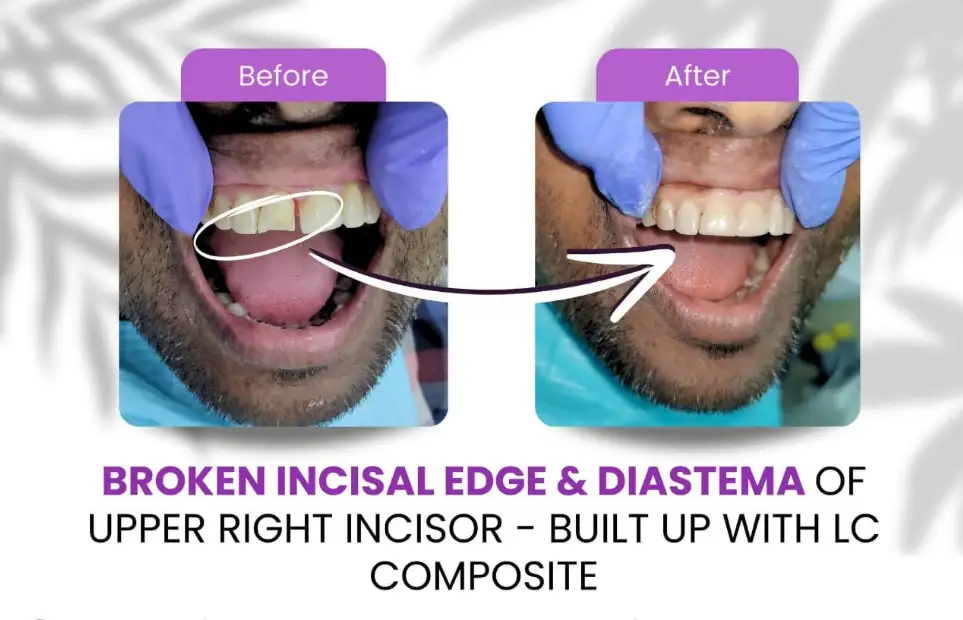 Before and after: a broken incisal edge and gap on an upper incisor rebuilt with composite
