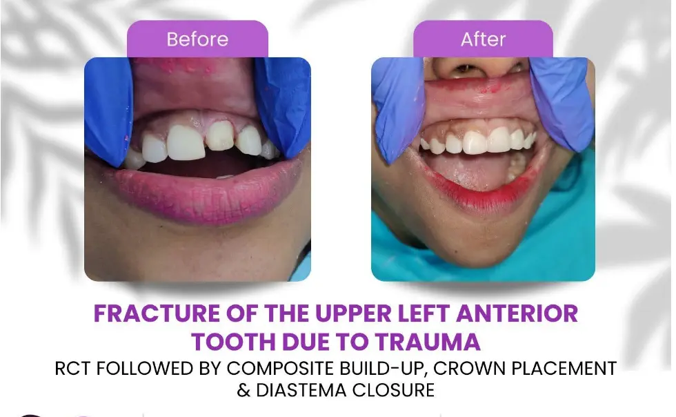 Before and after: an upper anterior tooth fractured by trauma restored with root canal and a crown