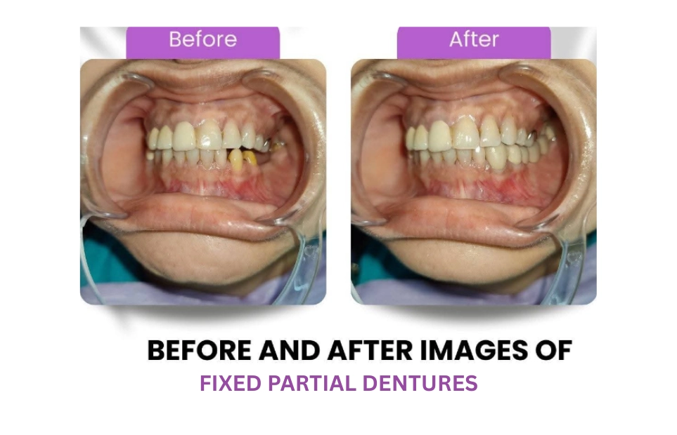 Before and after images of a fixed partial denture replacing a missing tooth