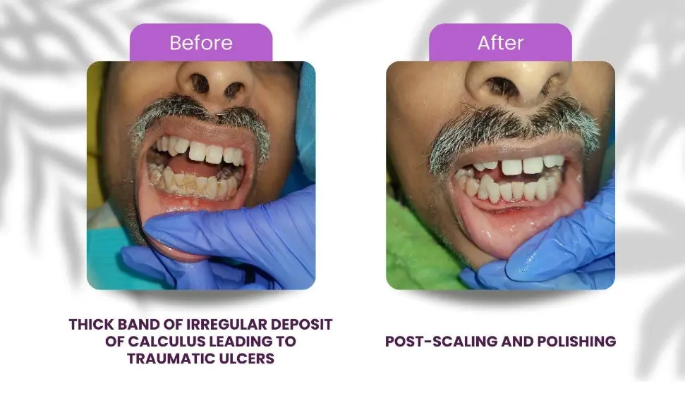Before and after: heavy calculus deposits removed by scaling and polishing