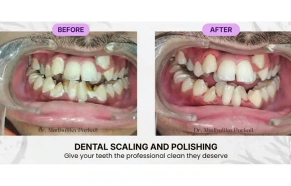 Scaling and polishing consultation at Radiant 32, Bhowanipore
