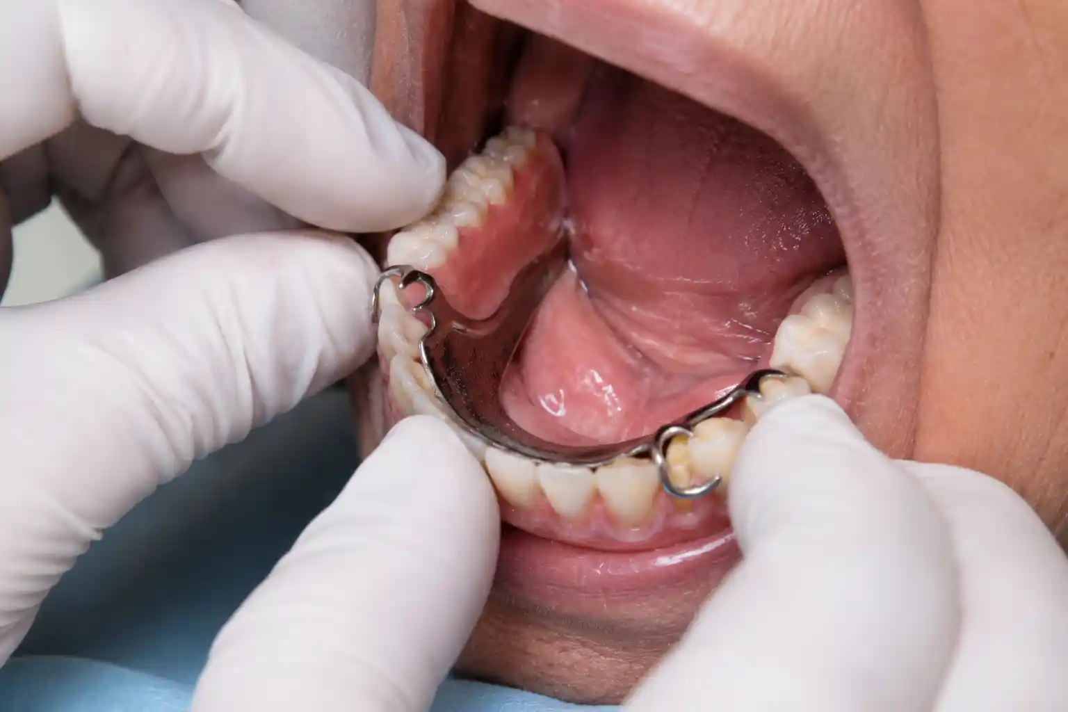 Dentures and partials