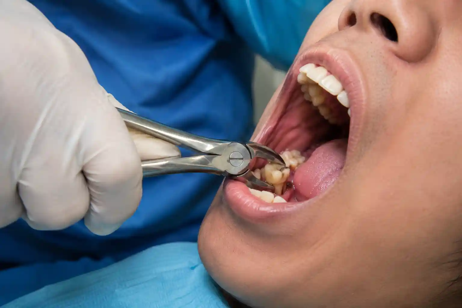 Tooth extraction